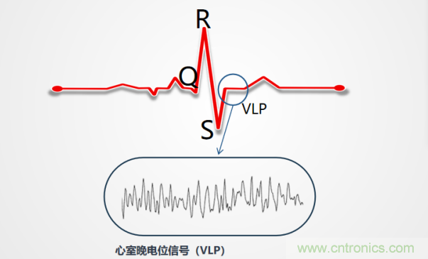 解決心電監測行業難題，曼森伯格的濾波技術獲國家知識產權局發明授權